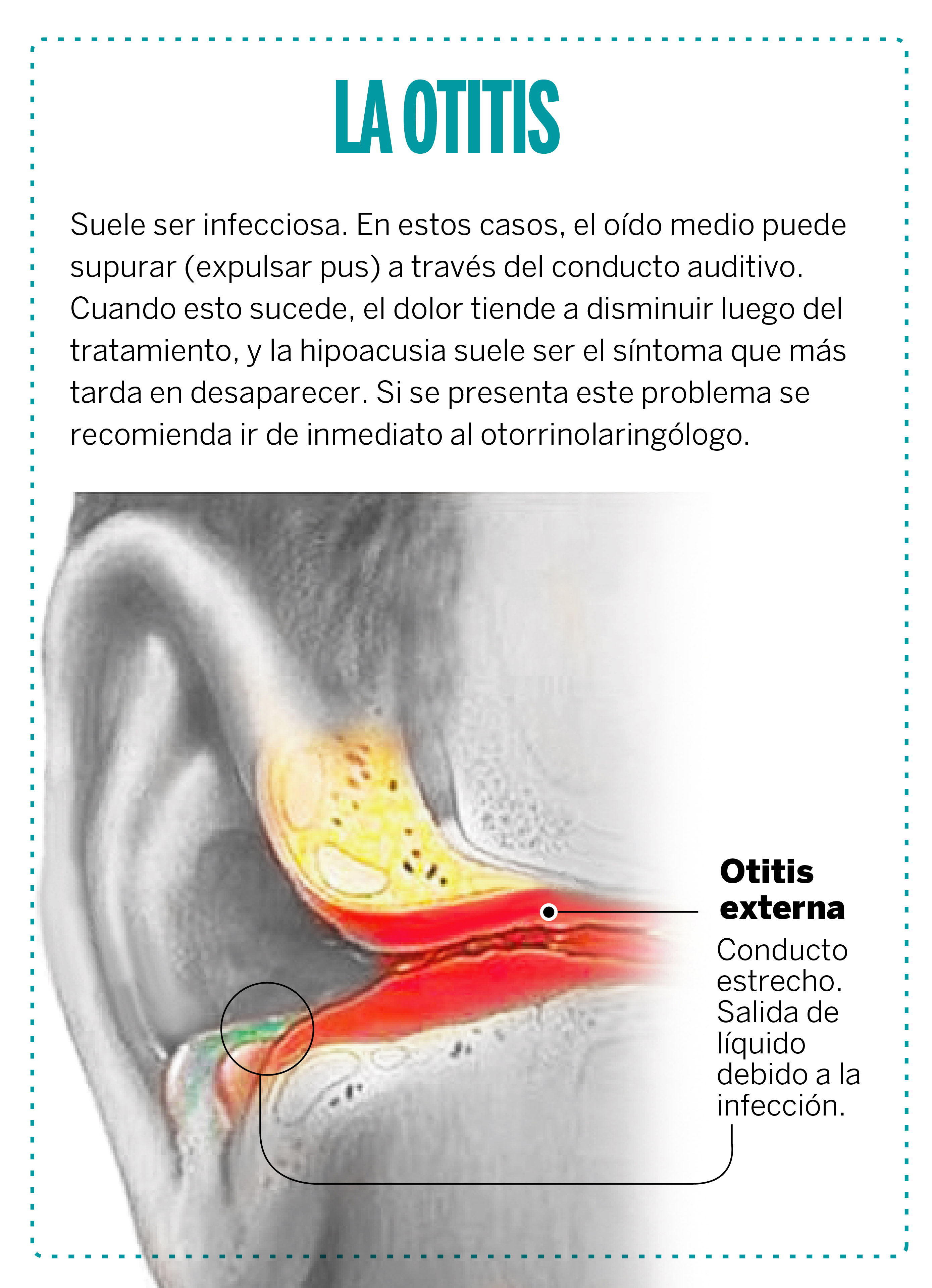 “El Dr. Pérez Albela recomienda qué hacer en caso de Otitis, ya que no causa problemas de audición si se trata adecuadamente