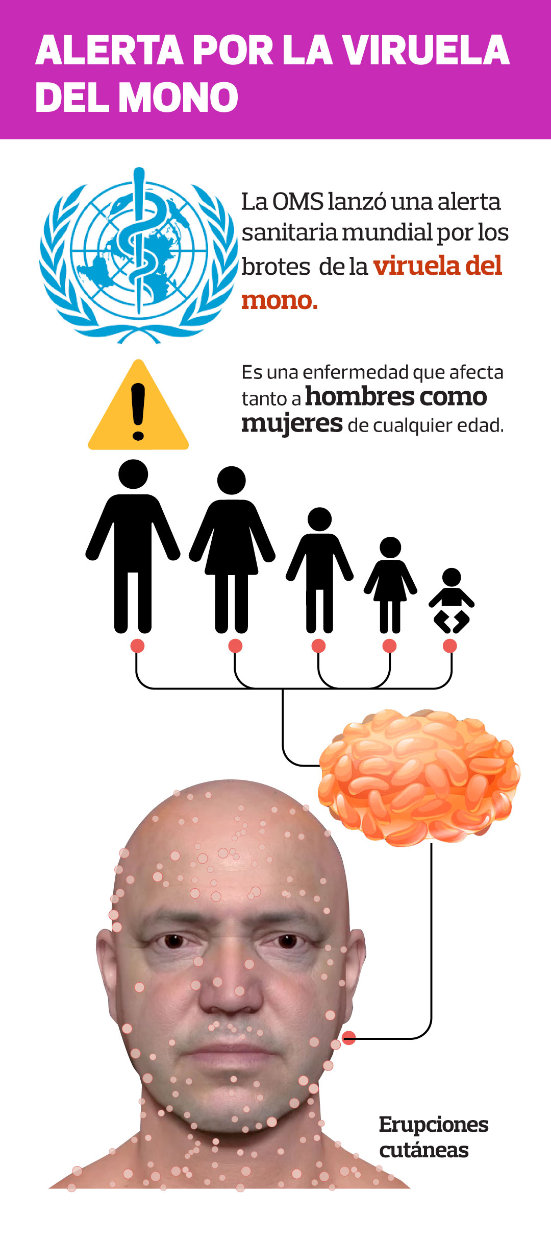 Qué es la viruela del mono, cómo se contagia y cuáles son sus síntomas