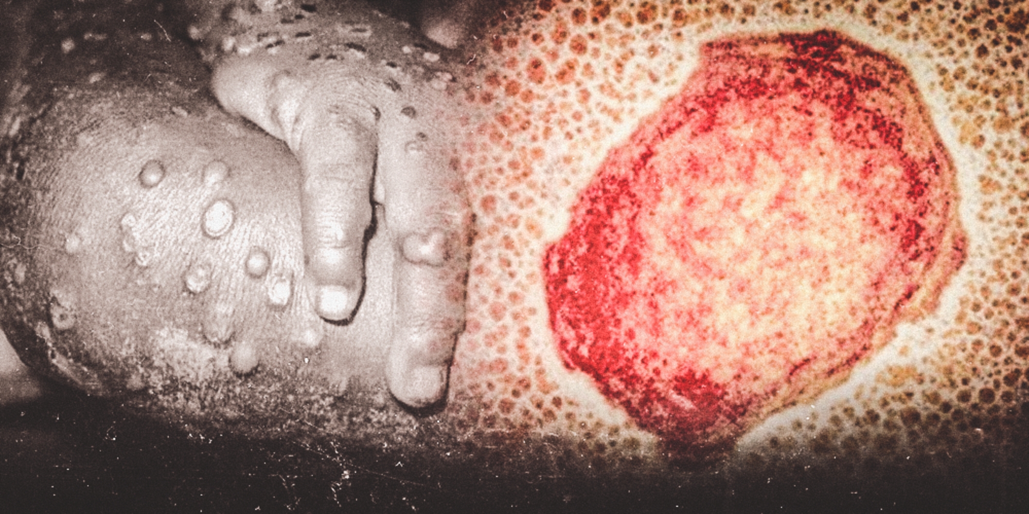 Qué es la viruela del mono, cómo se contagia y cuáles son sus síntomas