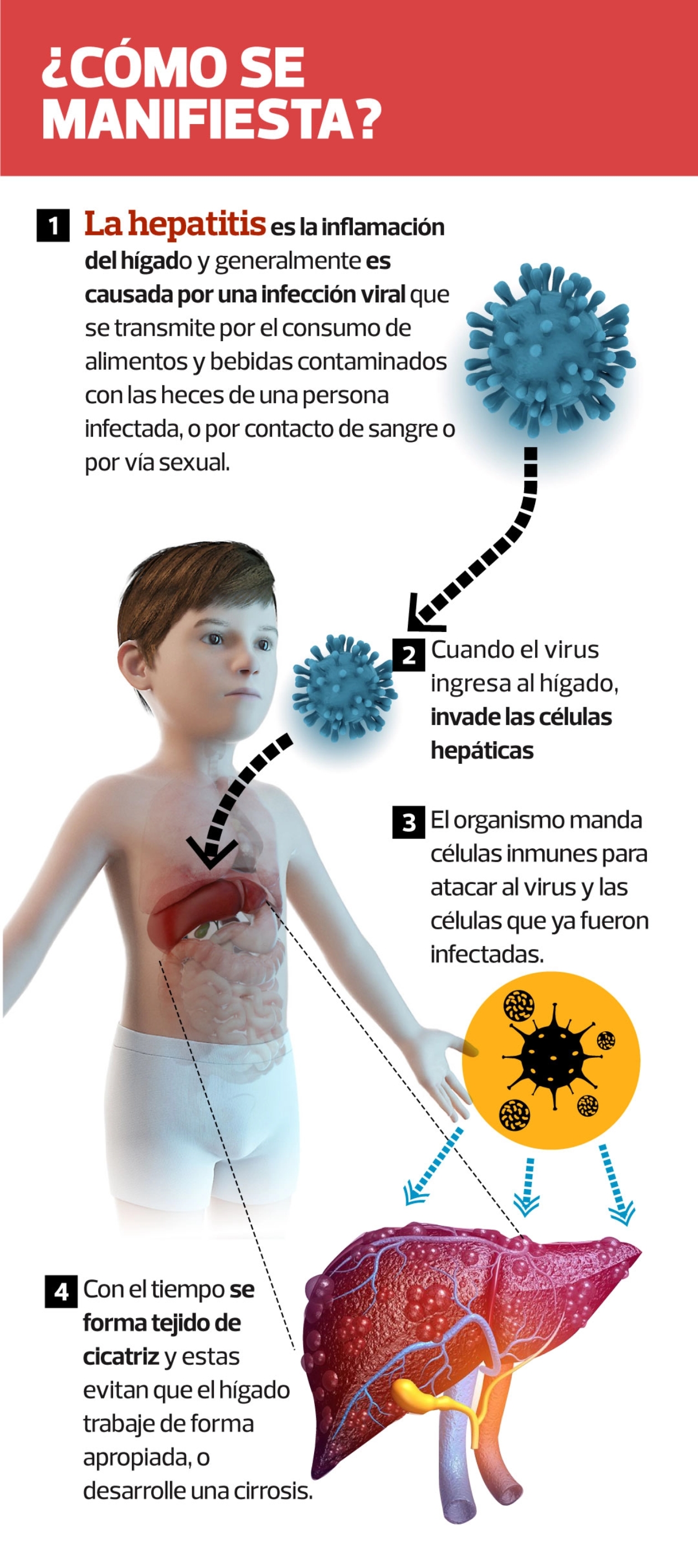 La peligrosa ¡Padres en alerta! Causas y prevención sobre la nueva hepatitis aguda en niños 